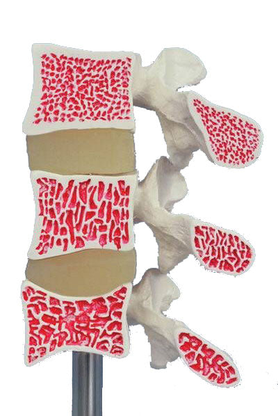 Osteoporose-Modell